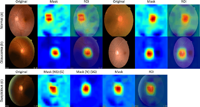 Figure 3 for 2sRanking-CNN: A 2-stage ranking-CNN for diagnosis of glaucoma from fundus images using CAM-extracted ROI as an intermediate input