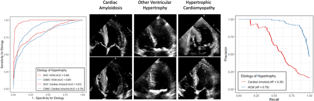 Figure 3 for High-Throughput Precision Phenotyping of Left Ventricular Hypertrophy with Cardiovascular Deep Learning
