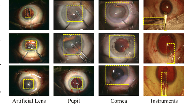 Figure 1 for DeepPyramid: Enabling Pyramid View and Deformable Pyramid Reception for Semantic Segmentation in Cataract Surgery Videos