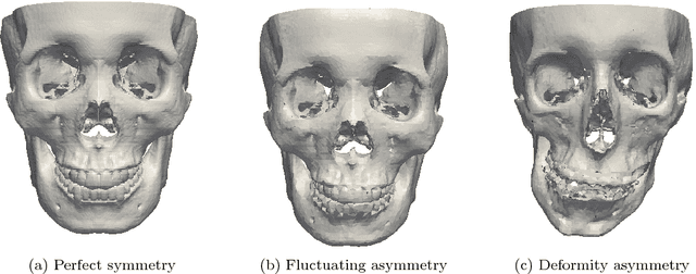 Figure 1 for Calculating the Midsagittal Plane for Symmetrical Bilateral Shapes: Applications to Clinical Facial Surgical Planning