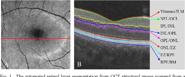 Figure 1 for DcardNet: Diabetic Retinopathy Classification at Multiple Depths Based on Structural and Angiographic Optical Coherence Tomography
