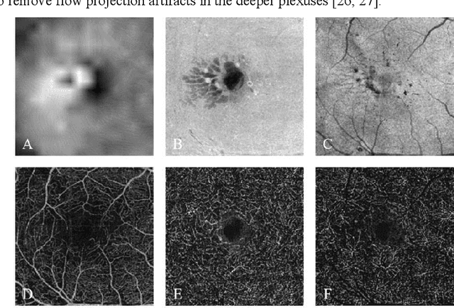Figure 3 for DcardNet: Diabetic Retinopathy Classification at Multiple Depths Based on Structural and Angiographic Optical Coherence Tomography