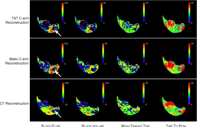 Figure 3 for Application of Time Separation Technique to Enhance C-arm CT Dynamic Liver Perfusion Imaging