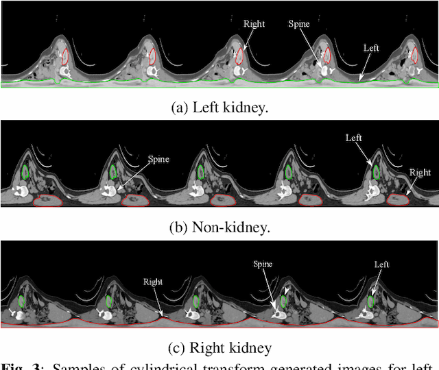 Figure 4 for Cylindrical Transform: 3D Semantic Segmentation of Kidneys With Limited Annotated Images