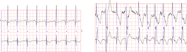 Figure 1 for ECG synthesis with Neural ODE and GAN models
