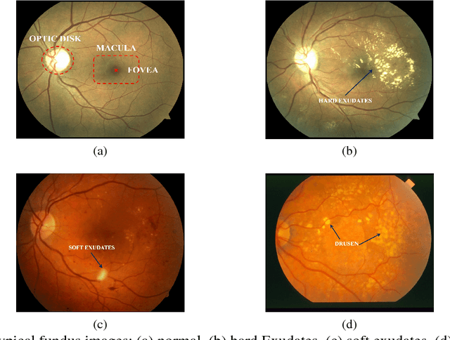 Figure 1 for Automatic Classification of Bright Retinal Lesions via Deep Network Features