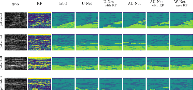 Figure 3 for W-Net: Dense Semantic Segmentation of Subcutaneous Tissue in Ultrasound Images by Expanding U-Net to Incorporate Ultrasound RF Waveform Data