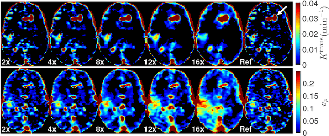 Figure 3 for Accelerated Reconstruction of Perfusion-Weighted MRI Enforcing Jointly Local and Nonlocal Spatio-temporal Constraints