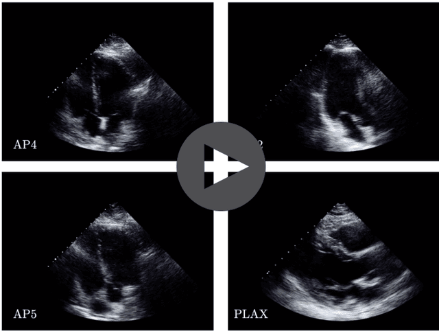Figure 4 for Echo-SyncNet: Self-supervised Cardiac View Synchronization in Echocardiography