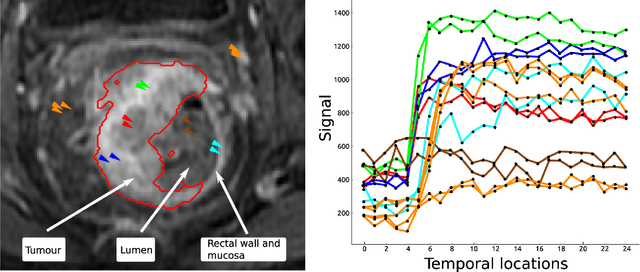 Figure 3 for Pieces-of-parts for supervoxel segmentation with global context: Application to DCE-MRI tumour delineation