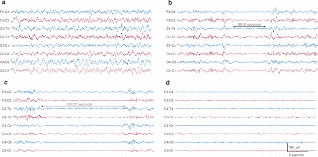 Figure 4 for Neonatal EEG graded for severity of background abnormalities in hypoxic-ischaemic encephalopathy