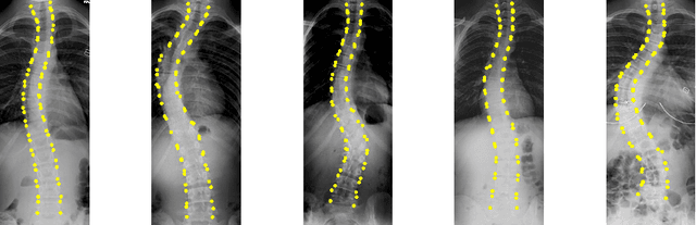 Figure 4 for Direct Estimation of Spinal Cobb Angles by Structured Multi-Output Regression