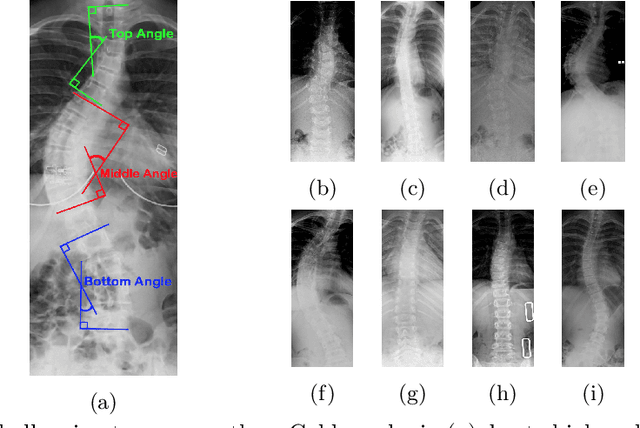 Figure 1 for Direct Estimation of Spinal Cobb Angles by Structured Multi-Output Regression