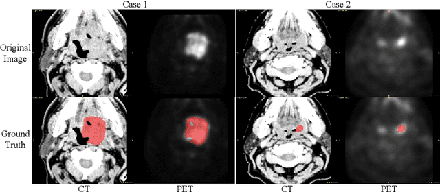 Figure 1 for Combining CNN and Hybrid Active Contours for Head and Neck Tumor Segmentation in CT and PET images