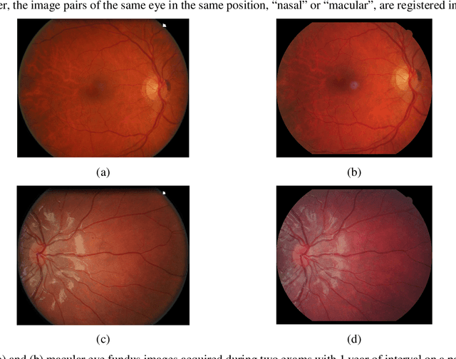 Figure 3 for Superimposition of eye fundus images for longitudinal analysis from large public health databases
