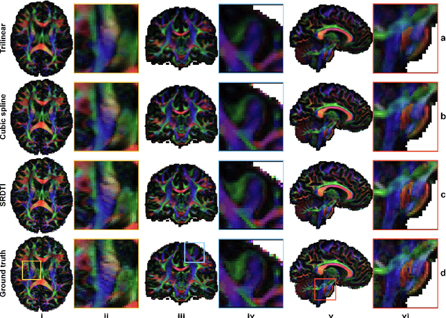 Figure 4 for SRDTI: Deep learning-based super-resolution for diffusion tensor MRI