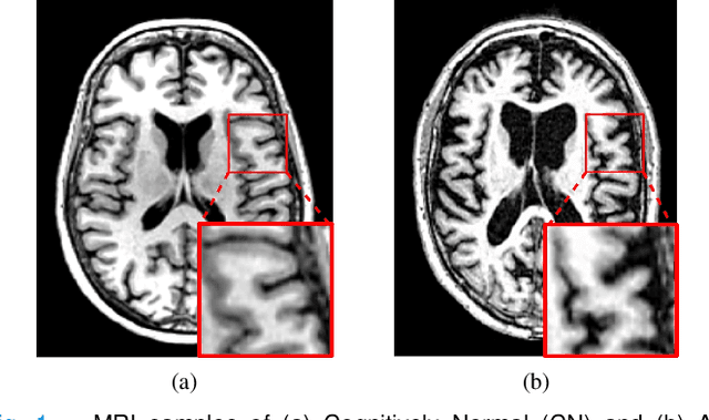 Figure 1 for A multi-stream convolutional neural network for classification of progressive MCI in Alzheimer's disease using structural MRI images