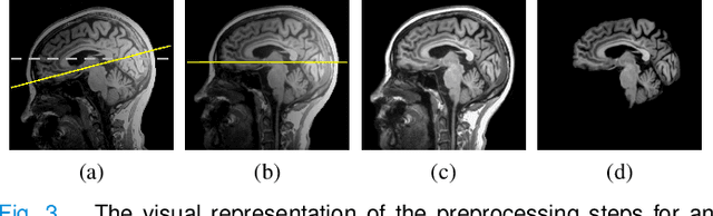 Figure 3 for A multi-stream convolutional neural network for classification of progressive MCI in Alzheimer's disease using structural MRI images