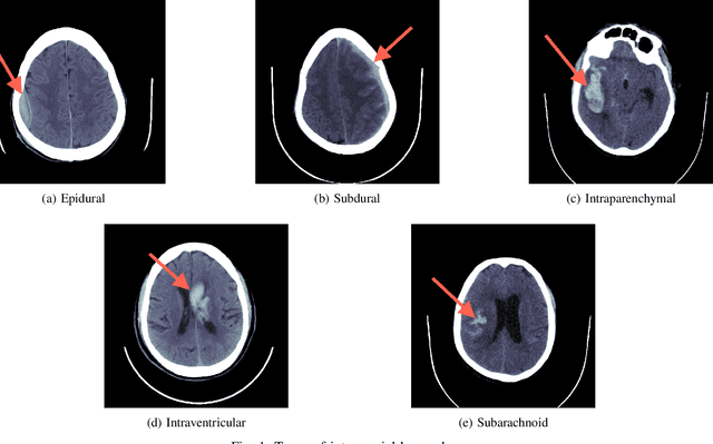 Figure 1 for Unsupervised Acute Intracranial Hemorrhage Segmentation with Mixture Models