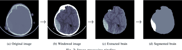 Figure 2 for Unsupervised Acute Intracranial Hemorrhage Segmentation with Mixture Models