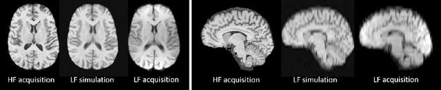 Figure 1 for Image Quality Transfer Enhances Contrast and Resolution of Low-Field Brain MRI in African Paediatric Epilepsy Patients