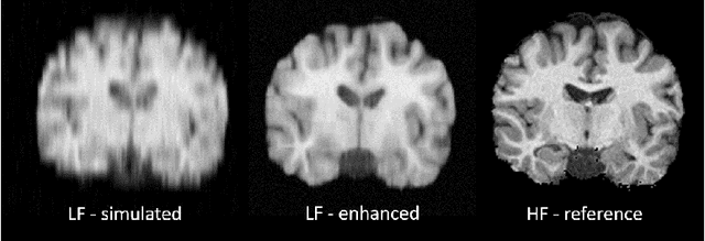 Figure 2 for Image Quality Transfer Enhances Contrast and Resolution of Low-Field Brain MRI in African Paediatric Epilepsy Patients
