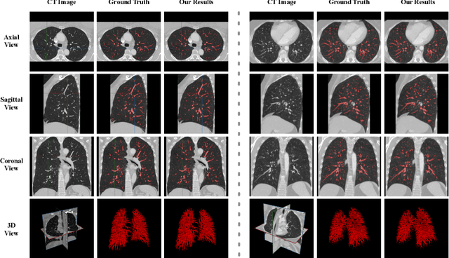 Figure 3 for Pulmonary Vessel Segmentation based on Orthogonal Fused U-Net++ of Chest CT Images
