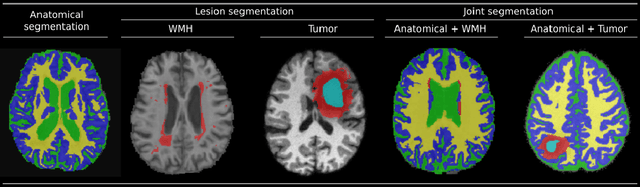 Figure 1 for Joint Learning of Brain Lesion and Anatomy Segmentation from Heterogeneous Datasets