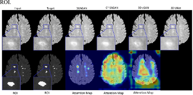 Figure 3 for Lesion-Specific Prediction with Discriminator-Based Supervised Guided Attention Module Enabled GANs in Multiple Sclerosis