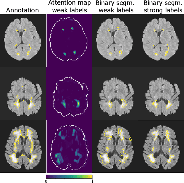Figure 3 for When Weak Becomes Strong: Robust Quantification of White Matter Hyperintensities in Brain MRI scans
