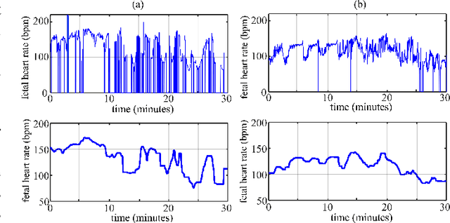 Figure 1 for Cardiotocography Signal Abnormality Detection based on Deep Unsupervised Models