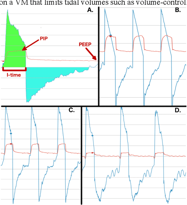 Figure 1 for Improving Mechanical Ventilator Clinical Decision Support Systems with A Machine Learning Classifier for Determining Ventilator Mode