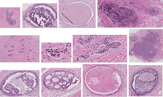 Figure 1 for Bag of Visual Words (BoVW) with Deep Features -- Patch Classification Model for Limited Dataset of Breast Tumours