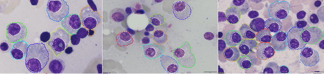Figure 1 for Multi-scale Regional Attention Deeplab3+: Multiple Myeloma Plasma Cells Segmentation in Microscopic Images