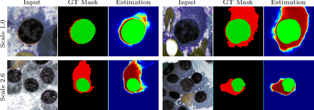Figure 4 for Multi-scale Regional Attention Deeplab3+: Multiple Myeloma Plasma Cells Segmentation in Microscopic Images