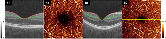 Figure 1 for Reconstruction of high-resolution 6x6-mm OCT angiograms using deep learning