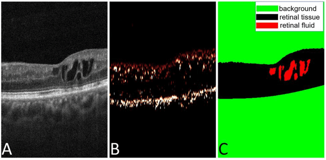 Figure 3 for Automated segmentation of retinal fluid volumes from structural and angiographic optical coherence tomography using deep learning