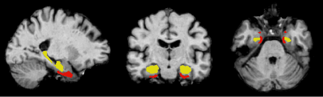 Figure 1 for Feature robustness and sex differences in medical imaging: a case study in MRI-based Alzheimer's disease detection