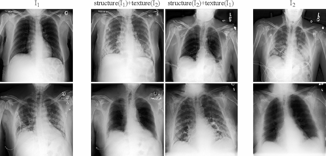 Figure 1 for Lung Swapping Autoencoder: Learning a Disentangled Structure-texture Representation of Chest Radiographs