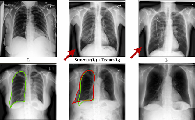 Figure 3 for Lung Swapping Autoencoder: Learning a Disentangled Structure-texture Representation of Chest Radiographs