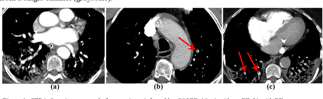 Figure 1 for Pulmonary embolism identification in computerized tomography pulmonary angiography scans with deep learning technologies in COVID-19 patients
