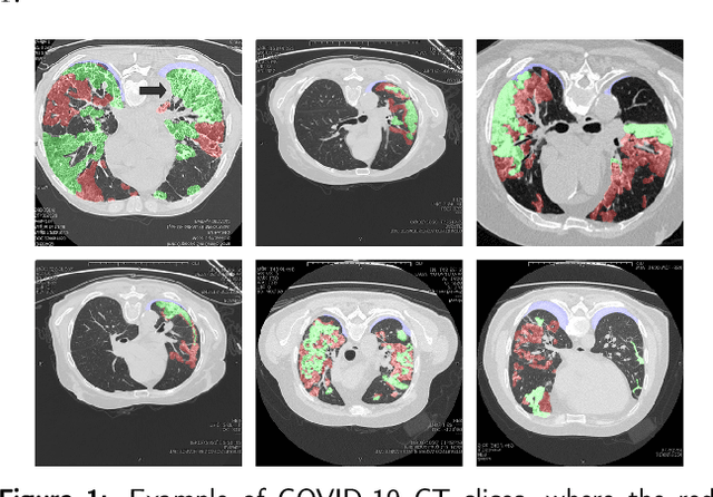 Figure 1 for D2A U-Net: Automatic Segmentation of COVID-19 Lesions from CT Slices with Dilated Convolution and Dual Attention Mechanism