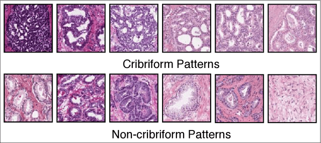 Figure 1 for Cribriform pattern detection in prostate histopathological images using deep learning models