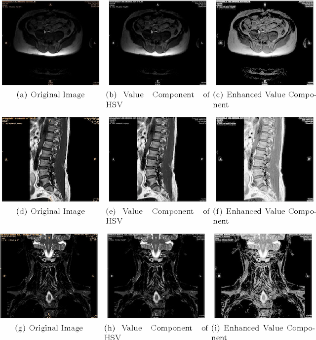 Figure 4 for An Improved Approach for Contrast Enhancement of Spinal Cord Images based on Multiscale Retinex Algorithm