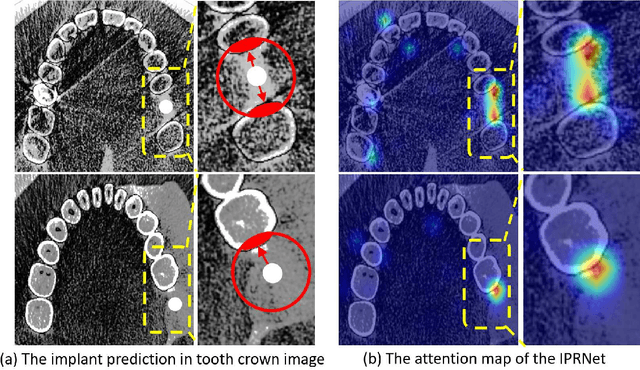 Figure 2 for ImplantFormer: Vision Transformer based Implant Position Regression Using Dental CBCT Data