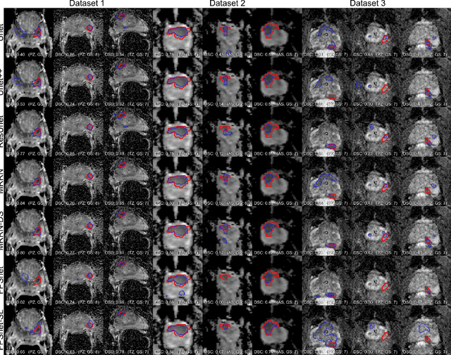 Figure 4 for Deep Learning Based Dominant Index Lesion Segmentation for MR-guided Radiation Therapy of Prostate Cancer
