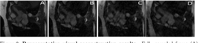 Figure 3 for Multi PILOT: Learned Feasible Multiple Acquisition Trajectories for Dynamic MRI
