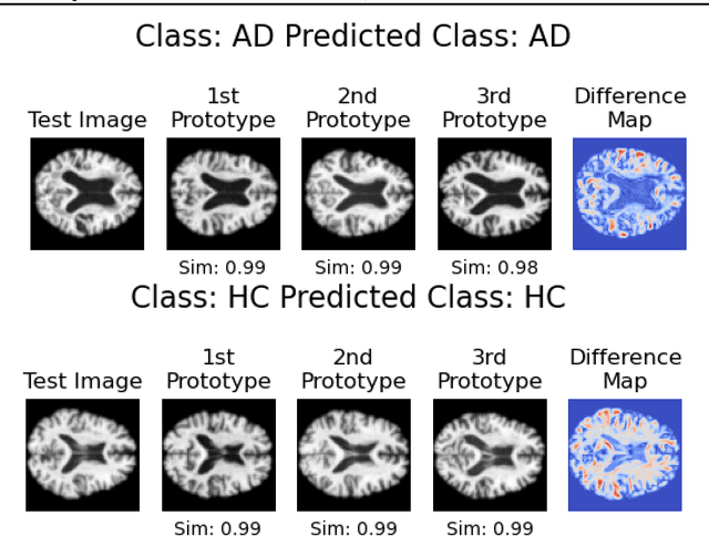 Figure 3 for Interpretable Alzheimer's Disease Classification Via a Contrastive Diffusion Autoencoder