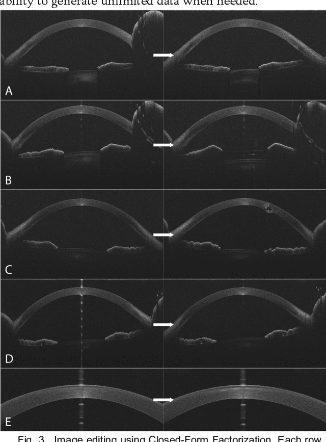 Figure 3 for Creating Realistic Anterior Segment Optical Coherence Tomography Images using Generative Adversarial Networks