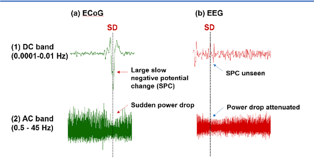 Figure 2 for Real-Time Non-Invasive Imaging and Detection of Spreading Depolarizations through EEG: An Ultra-Light Explainable Deep Learning Approach